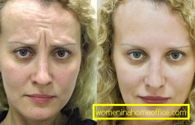 Botox prije i poslije: fotografija