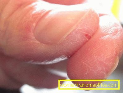 Koža na prstima se lomi: uzroci