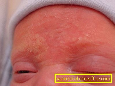 Seborični dermatitis na licu: simptomi